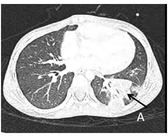 Figure 5: CT ANGIOGRAPHY Thorax-A Pulmonary window-Left Lung Lower Lobe abscess.