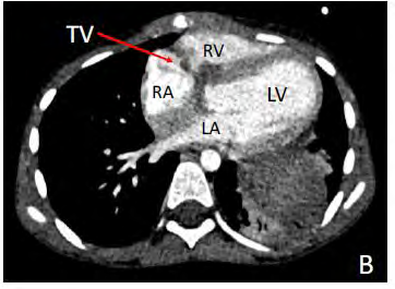Figure 6: CT ANGIOGRAPHY CARDIAC-B. Thickened tricuspid valve with infective vegetation is seen (TV Tricuspid valve, RA) RA-Right Atrium, LA-left atrium, LV- Left Ventricle, RV-Right Ventricle.
