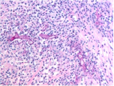 Figure 2: Mucormycosis exhibiting broad, aseptate, ribbon-like fungal hyphae disseminated in an inflammatory infiltrate of neutrophils and macrophages [14].