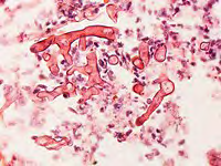 Figure 3: Mucormycosis delineating broad, pauci-septate hyphae disseminated in clusters of acute inflammatory cells [15].