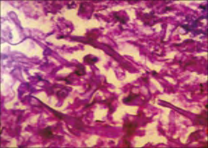 Figure 6: Mucormycosis depicting entangled, broad, ribbon-like, irregularly branching fungal hyphae [18].