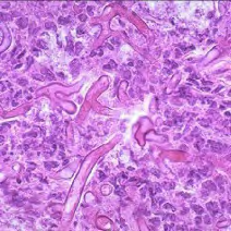 Figure 7: Mucormycosis exhibiting entangled, broad, ribbon-like fungal hyphae surrounded by accumulation of inflammatory cell [19].