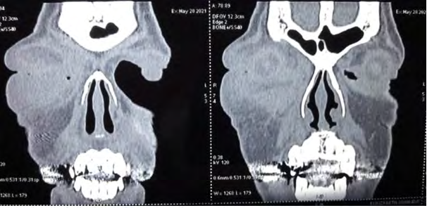 Figure 2: CT Paranasal sinus and orbit.