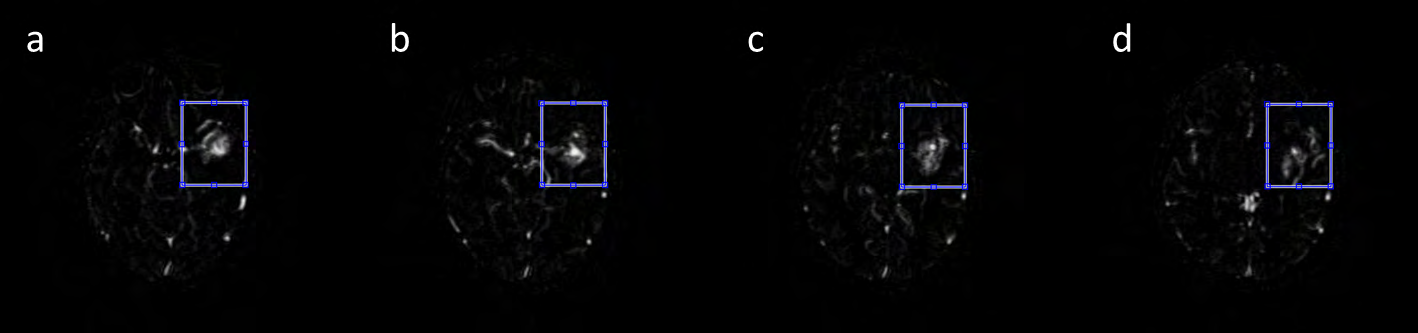 Figure 2: A ROI volume is defined to enclose the target nidus volume. The size of the ROI is determined by the largest x, y and z dimensions of the AVM region throughout all slices. The images show the ROI (blue rectangles) in different slices enclosing the AVM.