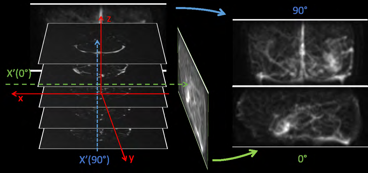 Figure 3: After the AVM sub-volume is extracted, projection onto the x’-z plane results in an MIP image. The left panel illustrates the stacked AVM volume and its reference coordinate frame. The right panel shows the projected AVM volume on two MIP images at 0° and 90°, respectively.