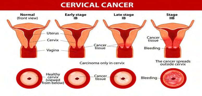 Figure 1: Stages of cervical cancer.