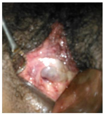 Figure 3: Showing fetal head after resection of transverse vaginal septum.