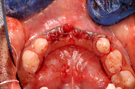 Figure 2: Intraoperative photograph after surgical site exposure and removal of calcified tissues (A), complete removal of lesion and lesion sac, coronal to the permanent tooth bud #23 (B), surgical site closure with interrupted sutures (C), and surgically removed lesion and lesion sac (*). Postoperative occlusal radiographs at 6-months (E), and 12-months (F) demonstrating altered eruption path of permanent teeth. Panoramic radiograph (G) taken after 36-months of the surgery demonstrated delayed eruption of #23 and #24 as compared to the contralateral incisors.