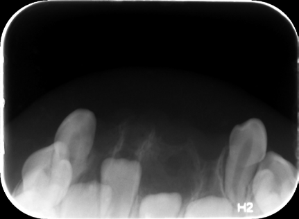 Figure 3: Hematoxylin and Eosin (H&E) stained sections: 5X (A) and 10X (B) magnification demonstrating numerous atypical “tooth-like” structures (*), enamel matrix (E), dentinal tubules (D), and dental pulp (P).