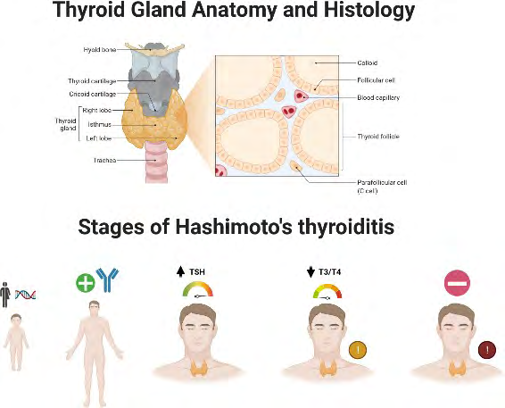 Figure 1: Thyroid Gland Anatomy and Histology and 5 Stages of Hashimoto autoimmune thyroid disease: 1) A person has a genetic predisposition to develop Hashimoto’s and thyroid function is normal, without attack on the thyroid. 2) A person may test positive for thyroid antibodies and may have changes consistent with Hashimoto’s but have normal TSH level. 3) Thyroid glands start to lose its ability to make enough hormone and there will be a slightly elevated TSH with normal T3/T4. More symptoms will be seen at this stage. 4) Thyroid glands have fully lost its ability to compensate, elevate TSH and low T3/T4 levels. With overt hypothyroidism, Hashimoto’s are often diagnosed. 5) Fully progression of the autoimmune response and other types of autoimmune conditions may develop. Created with BioRender.com