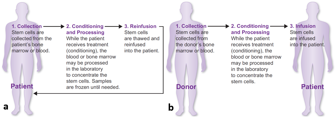 Figure 1: Demonstration of the major types of SCT (a) Autologous and (b) Allogeneic.