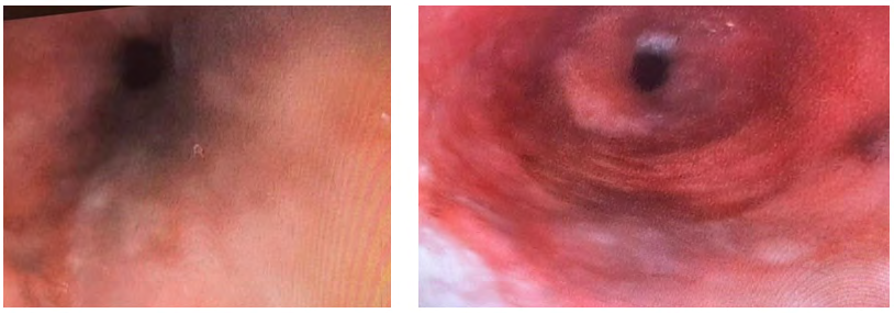 Figure 1: ** Endoscopic appearance of pigmented lesions in the esophagus.