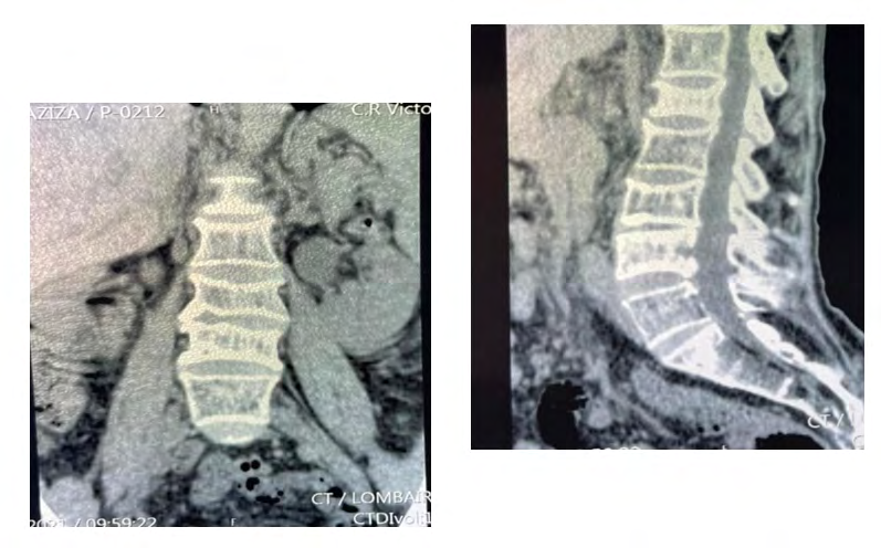 Figure 2: MRI face and profile images of dorso-lumbar bone lysis.