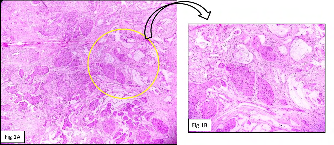Figure 1: A. Photomicrograph showing solid cystic tumor. (HE-40x); B: Photomicrograph showing tumor composed of cystic areas with mucous cells, nests of squamoid.