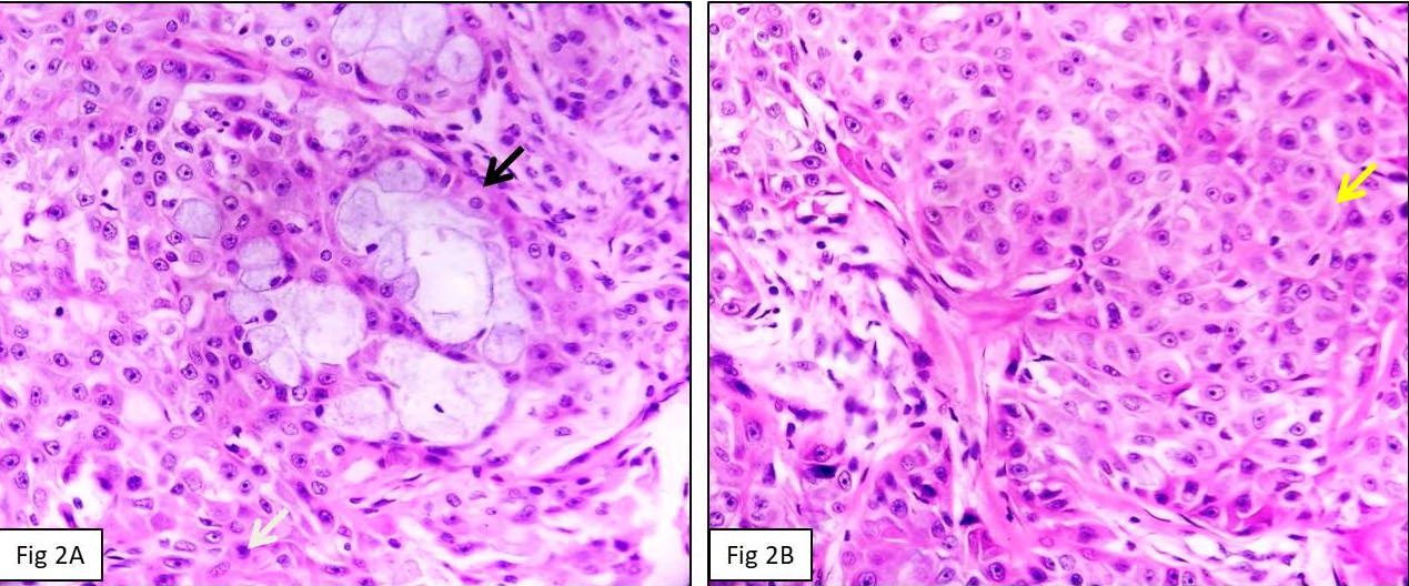Figure 2: A: Photomicrograph showing cluster of mucin producing mucous cells with foamy cytoplasm (black arrow) admixed with intermediate type cells (white arrow). (HE-400x); B: Photomicrograph showing nests of squamoid cells (yellow arrow). (HE-400x).