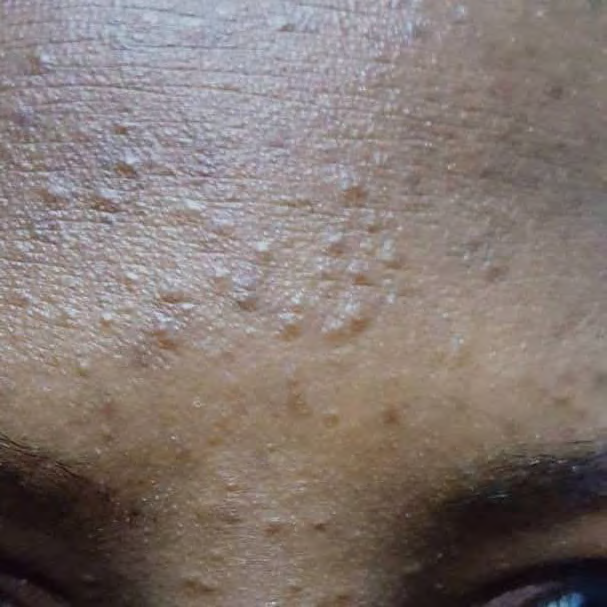 Figure 1: Eyelid syringoma in phototype 5.