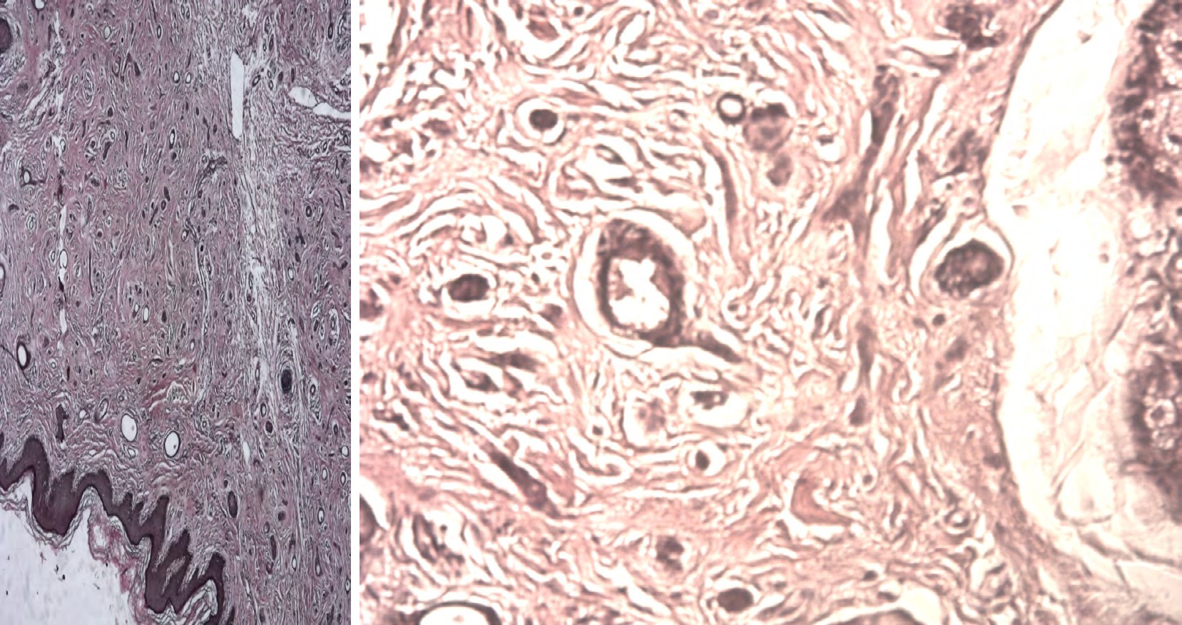 Figure 3: Histological images of eruptive vulvar syringoma observed in Bangui, Central African Republic, 2021 (X400 and X1000).