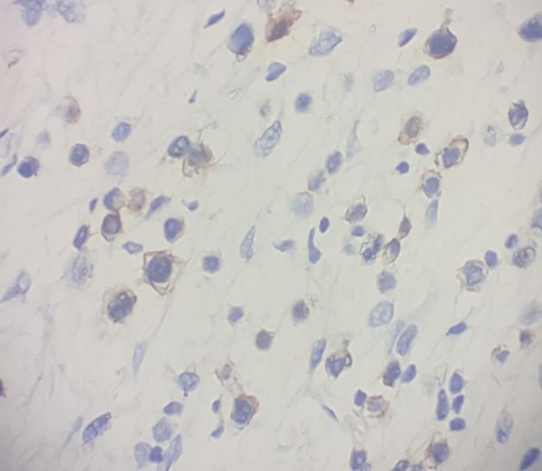 Figure 3: HER2 overexpression on tumor cells.