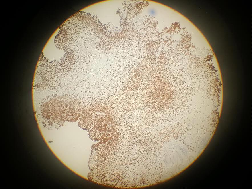 Figure 5: CD 138 expression on tumor cells. Expression are partially present on tumor cells (CD138, İmmuno histochemisty, X10) Combined-modality approaches involving TURBT with radiotherapy and simultaneous chemotherapy can be performed in patients with muscle invasive urothelial bladder cancer for those who are not a candidate for radical cystectomy [10]. Platinum-based chemotherapy is the preferred initial approach for systemic therapy in patients with metastatic disease [11]. For patients who are unable to receive cisplatin due comorbidities such as chronic renal disease like our patient has, options include a carboplatin-based regimen such carboplatin plus gemcitabine. In the EORTC 30986 study methotrexate / carboplatin / vinblastine (M-CAVI) treatment compared with carboplatin plus gemcitabine (GC). The trial suggests that GC has similar efficacy with M-CAVI. For having a better toxicity, GC can be preferred in patients with impaired renal function or a poor performance status (ECOG ≥2) for combination chemotherapy [12]. In patients with metastatic urothelial carcinoma single-agent chemotherapy such as adriamycin can be a treatment option either in the first-line or in previously treated patients. Our patient did not receive adriamycin because cardiac performance deteriorated after a single dose of adriamycin administration. Concurrent capecitabine and radiation therapy were shown to be well tolerated and effective in elderly patients with urothelial carcinoma [13]. Weekly paclitaxel was given for 6 months following radiotherapy which resulted in analmost complete response. Recently, C Messina et al published ametastatic PUC case who achieved remission following carboplatin and paclitexel combination [14]. Our patient is the second case responding to paclitaxel following chemoradiotherapy for the metastatic lesion of PUC. Patient's quality of life improved significantly. We thought chemotherapy responsiveness of this rare tumor is important and should be reported.