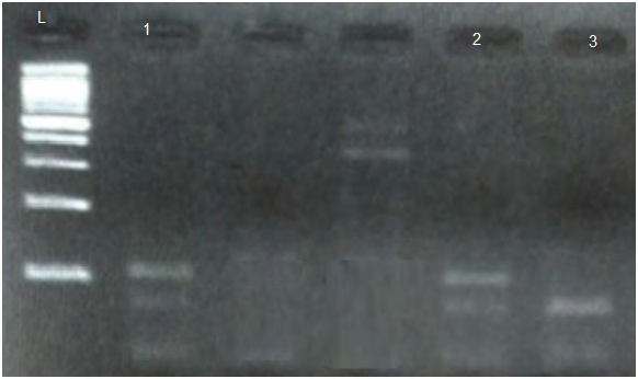 Figure 2: Shows results of PCR-base restriction analysis of MTHFR A1298T polymorphism on 3% agarose electrophoresis. The digested fragment length 105,77, 28bp in lane 1,2 indicates (AC genotype), while fragment lengths 77, 28bp in lane 3 indicates (AA genotype). L: ladder, 100 bp ladder.
