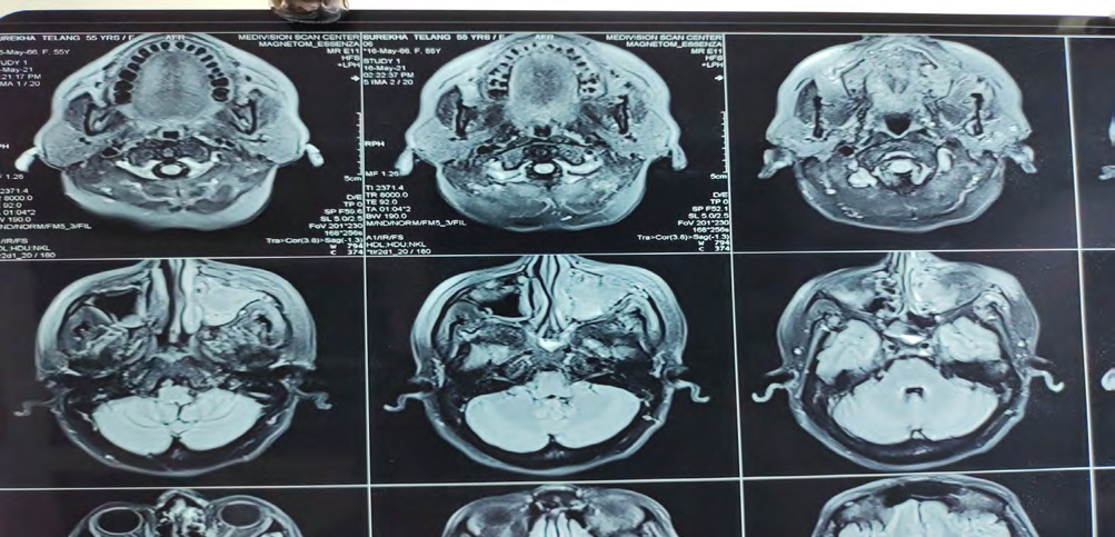 Figure 12: Pre-Operative MRI Images.