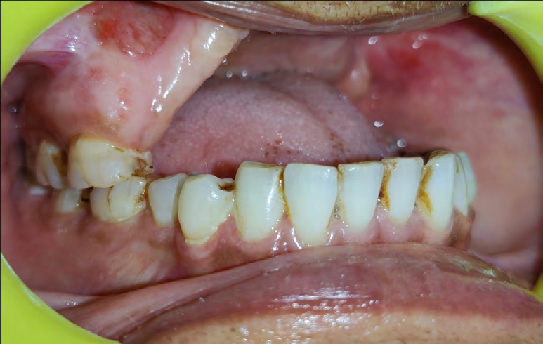 Figure 13: Post-Operative Follow-Up 1 Month.