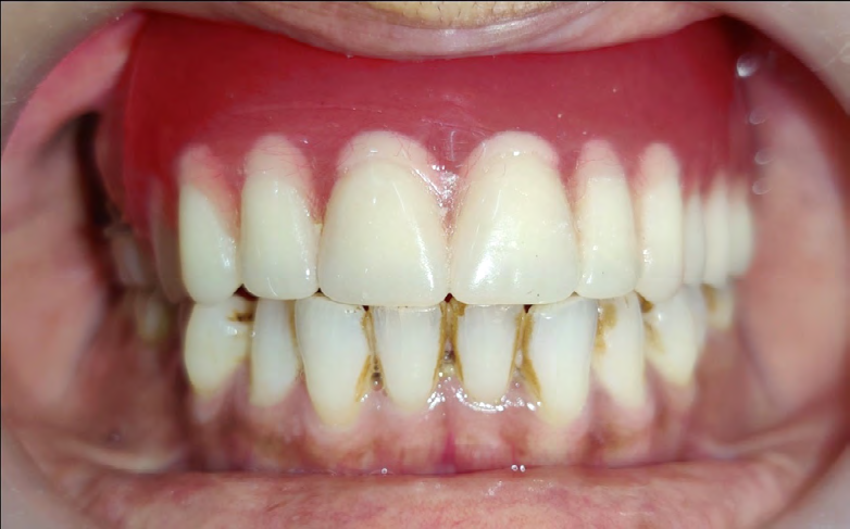 Figure 15: Prosthetic Rehabilitation-Frontal View.