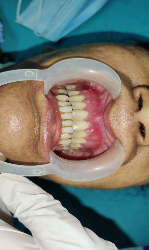 Figure 2: Pre-Operative Intra-Oral Frontal View.