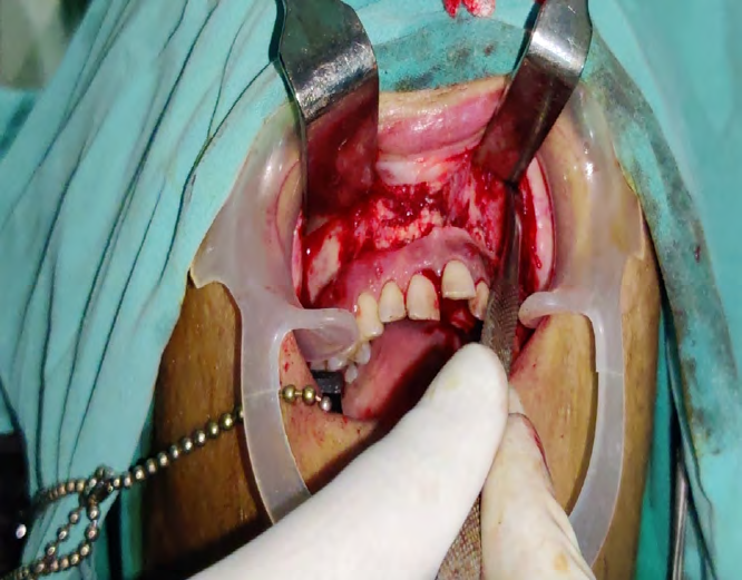 Figure 6: Incision.