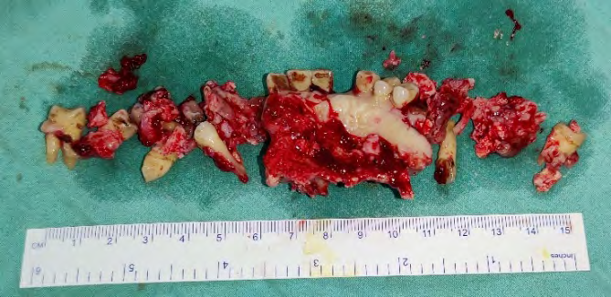 Figure 9: Resected Maxilla Inferiorly with Extracted Teeth.