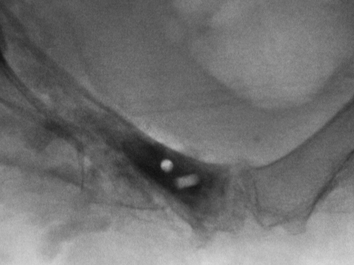 Figure 7: Post placement of calcium phosphate into pubic rami, AP view.