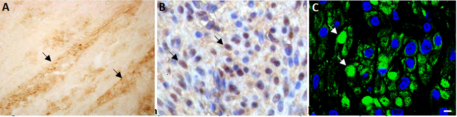 Figure 1: GPER Distribution in Myometrium. (A): GPER- ir cells (black arrows) in myometrium connective tissue (Diaminobenzidine immunoperoxidase (DABIP)). (B): GPER-ir (DAB) cells with nuclear reaction (black arrows). Nuclei have been counterstained with haematoxylin. (C-D): Confocal images showing GPER-ir cells (green immunofluorescence (GIF)) with nuclear reaction (white arrows). Nuclei have been counterstained with DAPI. Scale bar: 5µm.