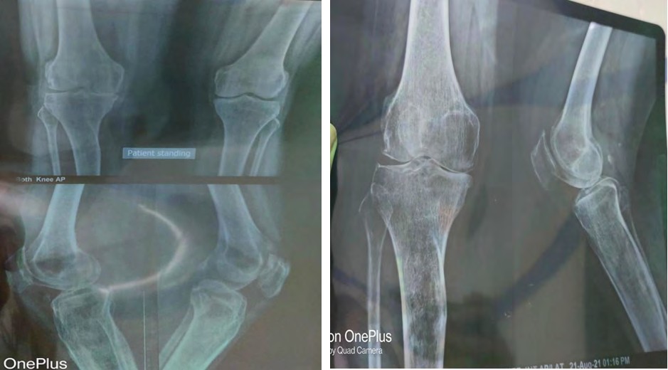 Figure 1: X-Ray Images of Knee.
