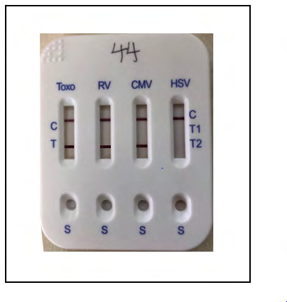 Figure 1: Picture showing a five in one Bio-System Torch Test Panel Kit positive for Toxo, CMV, HSV-1 and HSV-2.