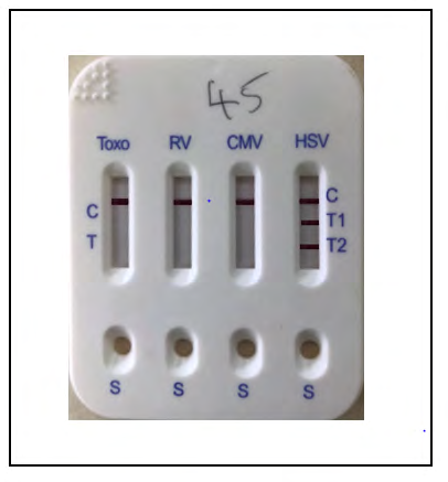 Figure 2: Picture showing a five in one Bio-System Torch Test Panel Kit negative for Toxo, RV, CMV, HSV-1 and HSV-2.