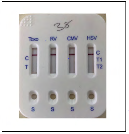 Figure 4: Picture showing a five in one Bio-System Torch Test Panel Kit positive for both HSV-1 and HSV-2.