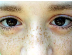 Figure 1: Ephelis exhibiting light and dark brown macules along with small patches distributed upon upper cheeks and bridge of nose [9].