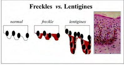 Figure 2: Ephelis demonstrating pigmented patches with normal quantities of melanocytes [10].