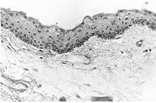 Figure 4: Ephelis enunciating acanthosis, hyperkeratosis and spongiosis of superimposed epidermis with dermal accumulation of melanocytes [12].