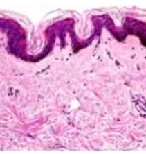 Figure 5: Ephelis exemplifying acanthosis, hyperkeratosis and parakeratosis of stratified squamous epithelium with accumulated dermal melanocytes imbued with significant melanin [13].