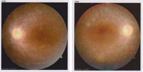 Figure 1: Fundus photograph of both eyes showing multiple bony spicules in the periphery, pale disc and arteriolar attenuation.