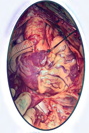 Figure 1: Ventral Aorta Repair - Ascending Aorta to Infra- diaphragmatic supra celiac aorta bypass.