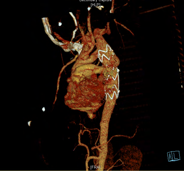 Figure 2: Volume rendered image- Endovascular stenting for coarctation of aorta.