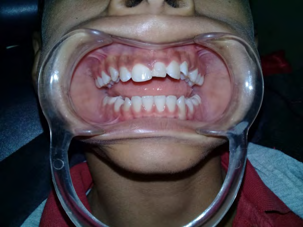Figure 1: Panoramic view of the patient’s mixed dentition.