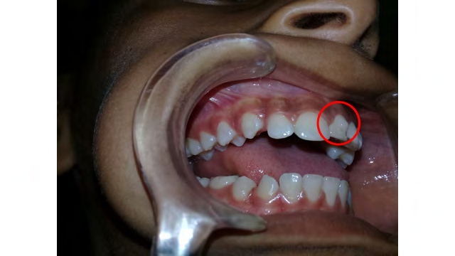 Figure 2: Lateral view of the palatinal cingulate of the mesiodens.