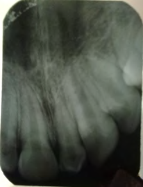 Figure 3: Periapical radiograph of the supernumerary tooth.