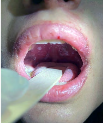 Figure 1: Shows the bilateral peritonsillar abscess in our case.