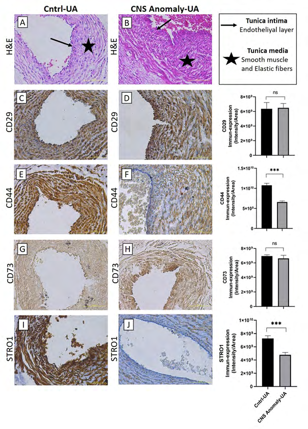 Figure 3: Hematoxylin-eosin staining in the umbilical artery and showing general morphology (A-B). Immun-expressions of CD29 in umbilical artery between groups and density/area significance analysis (C-D), immuno-expressions of CD44 in umbilical artery between groups and density/area significance analysis (E-F), immuno-expressions of CD73 in umbilical artery between groups and density/area significance analyzes (G-H) and immuno-expressions of STRO1 in the umbilical artery between groups and density/area significance analyzes (I-J) are given. Scale bar 50µM and microscope magnification 40x.