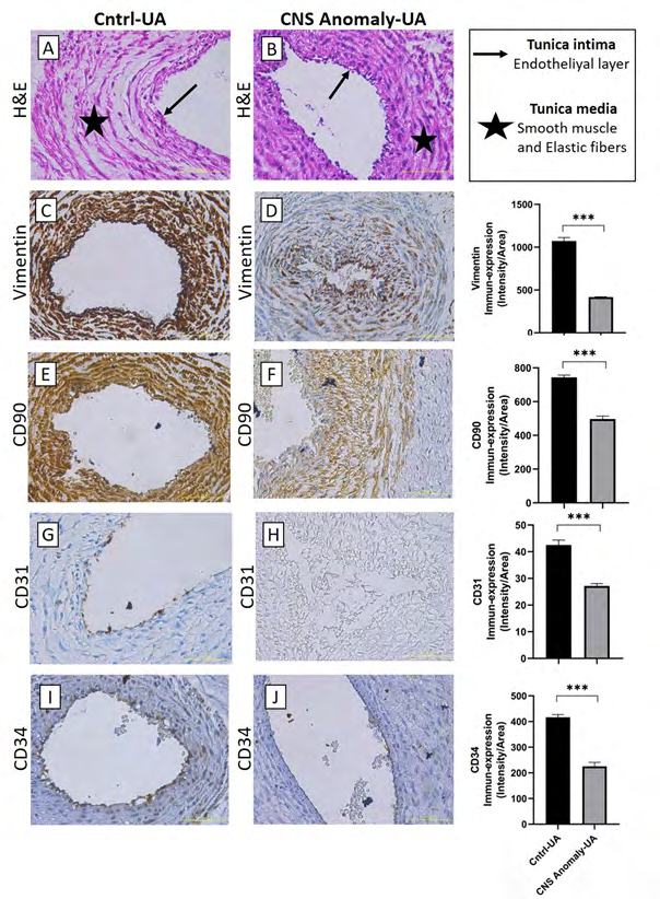 Figure 4: Hematoxylin-eosin staining in the umbilical artery of the control group and fetal cords with CNS anomalies and general morphology (A-B). Immun-expressions of Vimentin between groups in the umbilical artery and density/area significance analysis (C-D), immuno-expressions of CD90 between groups in the umbilical artery and density/area significance analysis (E-F), immune-expressions of CD31 between groups in the umbilical artery. And density/area significance analyzes (G-H) and immuno-expressions of CD34 in the umbilical artery between groups and density/area significance analyzes (I-J) are given. Scale bar 50µM and microscope magnification 40x.