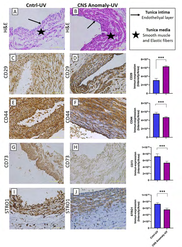 Figure 5: Hematoxylin-eosin staining in the umbilical vein of the control group and fetal cords with CNS anomalies and general morphology (A-B). Immune-expressions of CD29 between groups in the umbilical vein and density/area significance analysis (C-D), immuno-expressions of CD44 between groups in the umbilical vein and density/area significance analysis (E-F), immune-expressions of CD73 between groups in the umbilical vein and density/area significance analyzes (G-H) and immuno-expressions of STRO1 in the umbilical vein between groups and density/area significance analyzes (I-J). Scale bar 50µM and microscope magnification 40x.